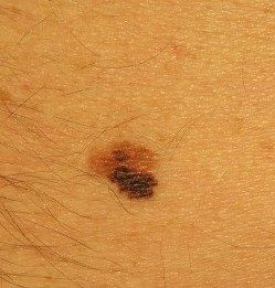 Suspekt malignt melanom