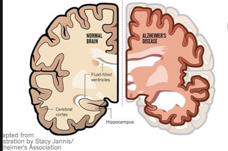 Illustrasjon av frisk hjerne og hjerne med hgjernesvinn (demens)